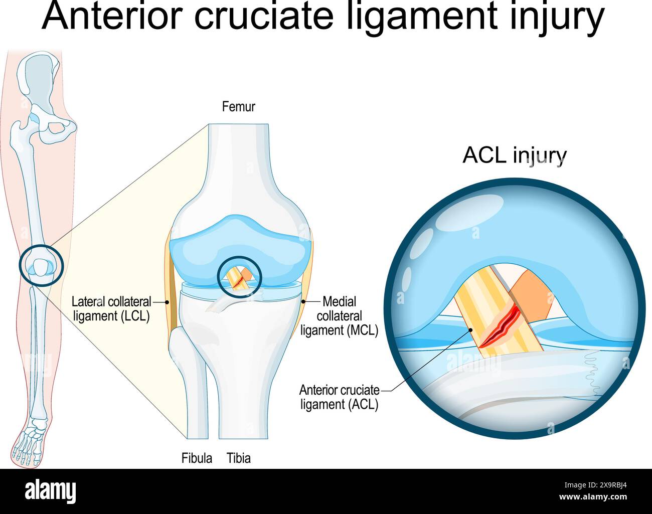 Lesione del legamento crociato anteriore. Primo piano di un'articolazione del ginocchio umano. Trauma al ginocchio come lacerazione o distorsione del legamento crociato anteriore. Infortunio sportivo. Vettore Illustrazione Vettoriale