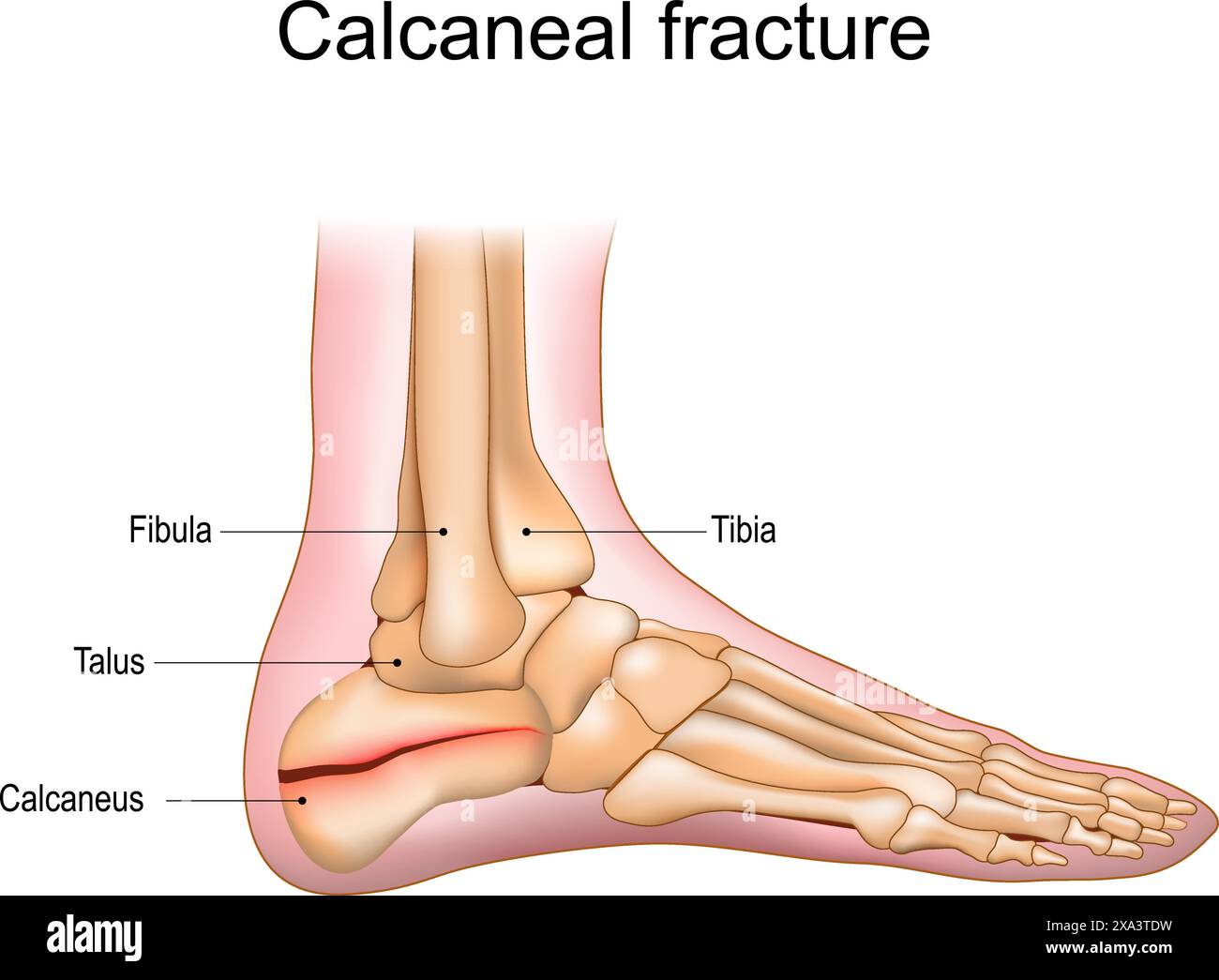 Frattura del calcagno. Trauma dell'osso del tallone. Lesioni al piede. Anatomia delle articolazioni del piede. Illustrazione vettoriale Illustrazione Vettoriale