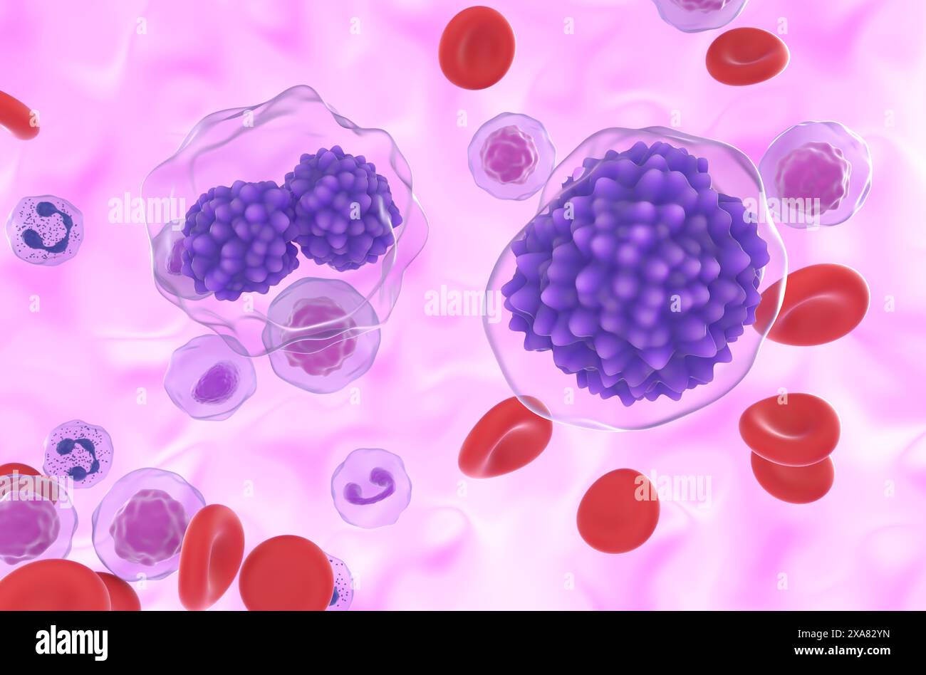 Leucemia plasmacellulare (PCL) - Vista ravvicinata illustrazione 3d. Foto Stock
