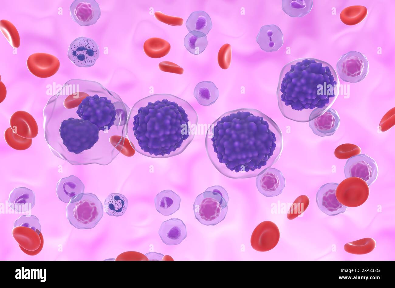 Leucemia plasmacellulare (PCL) - Vista isometrica illustrazione 3d. Foto Stock