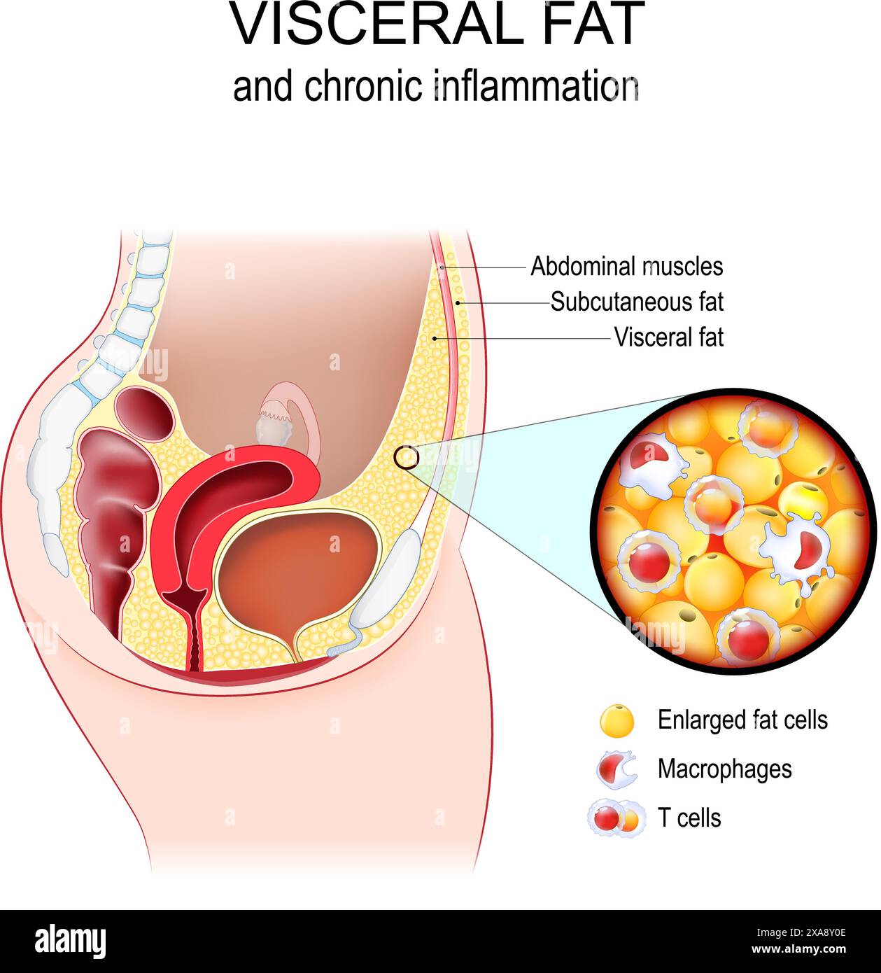 Grasso viscerale e infiammazione cronica. Sezione trasversale dell'addome femminile con muscolo addominale, grasso sottocutaneo e viscerale. Primo piano della tiss adiposa Illustrazione Vettoriale