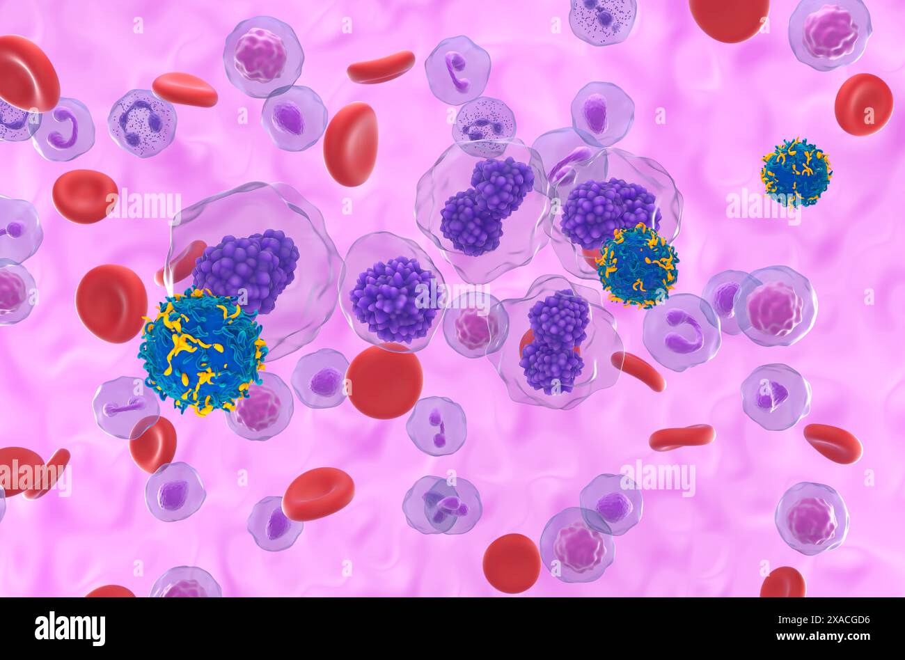 Terapia a cellule T di CAR nella leucemia a cellule del plasma (PCL) - Vista isometrica illustrazione 3d. Foto Stock