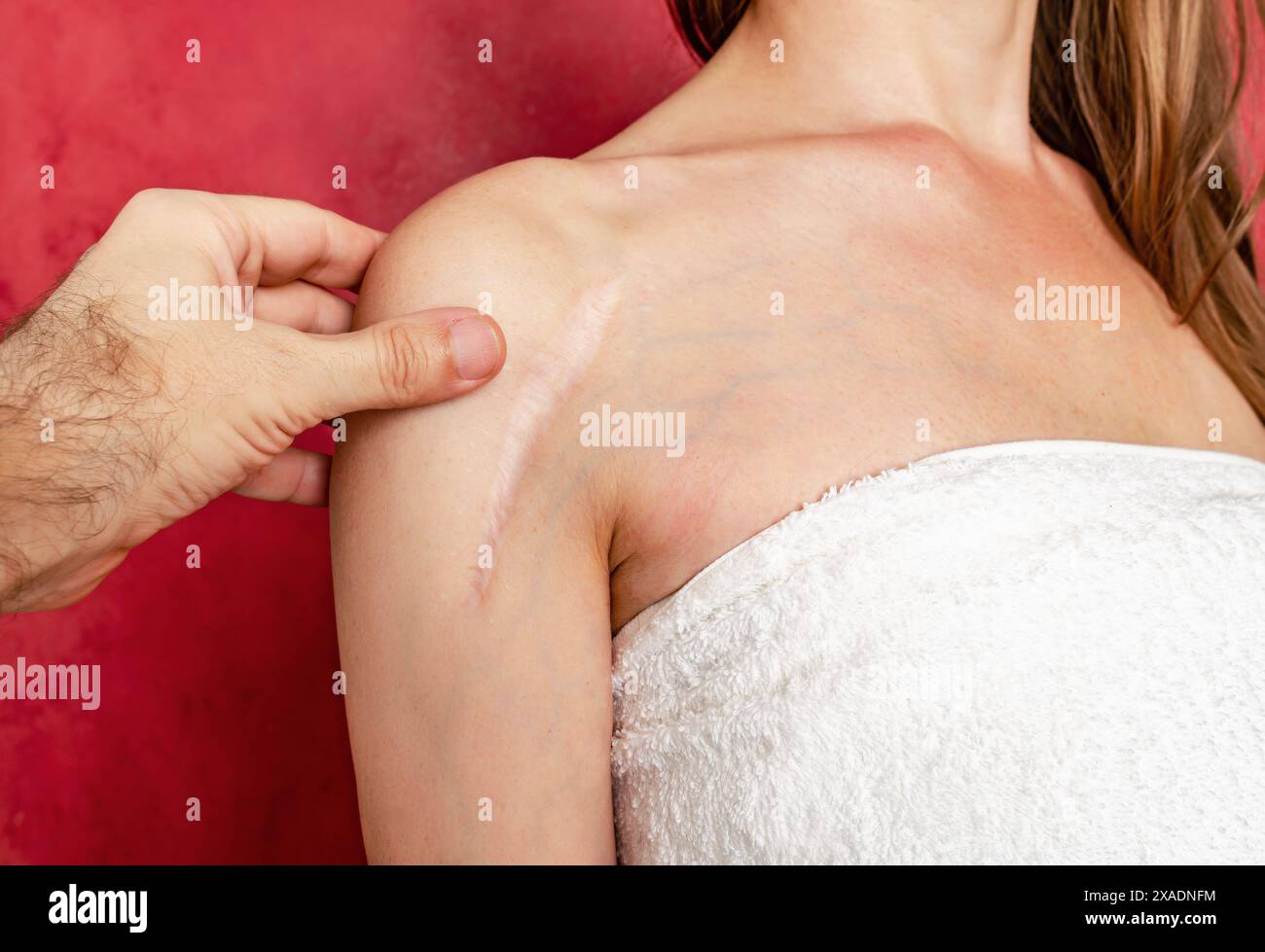 Man Hand esamina una cicatrice postoperatoria sulla spalla di una donna. Guarigione di cicatrici, trattamento di cicatrici sulla pelle Foto Stock
