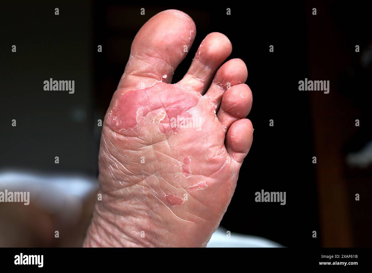 Primo piano dei piedi asciutti. Peeling e piede incrinato. Infezione micotica o piede dell'atleta, pelle secca, dermatite, eczema, psoriasi, piedi sudati o. Foto Stock