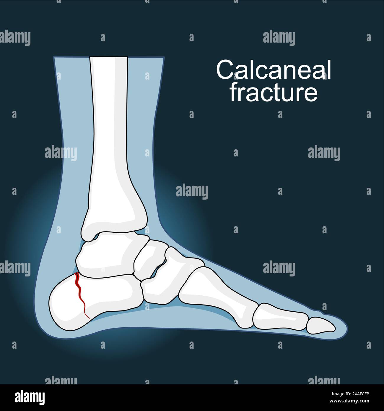 frattura-calcaneare-immagini-e-fotografie-stock-ad-alta-risoluzione-alamy