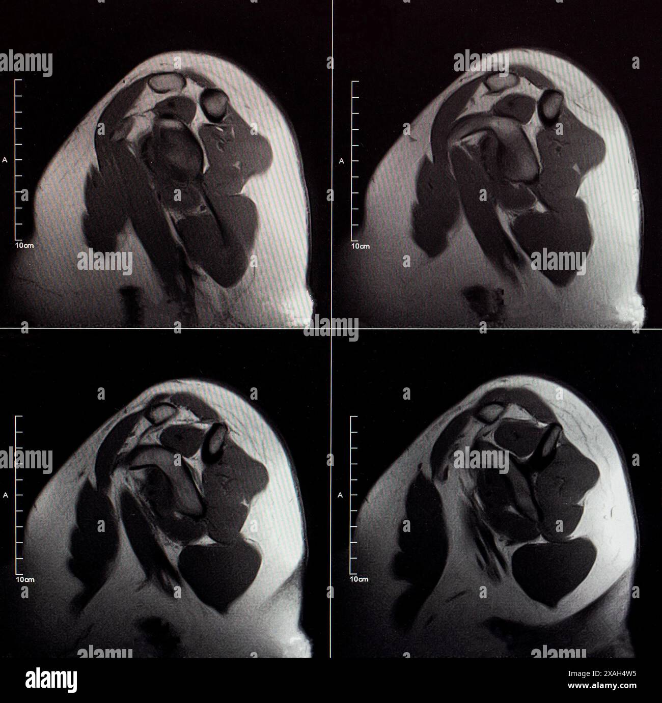 Immagine MRI dell'articolazione della spalla dopo una frattura e una lussazione. Impressione di frattura della testa dell'omero. Danno alla capsula articolare, deformattazione articolare Foto Stock