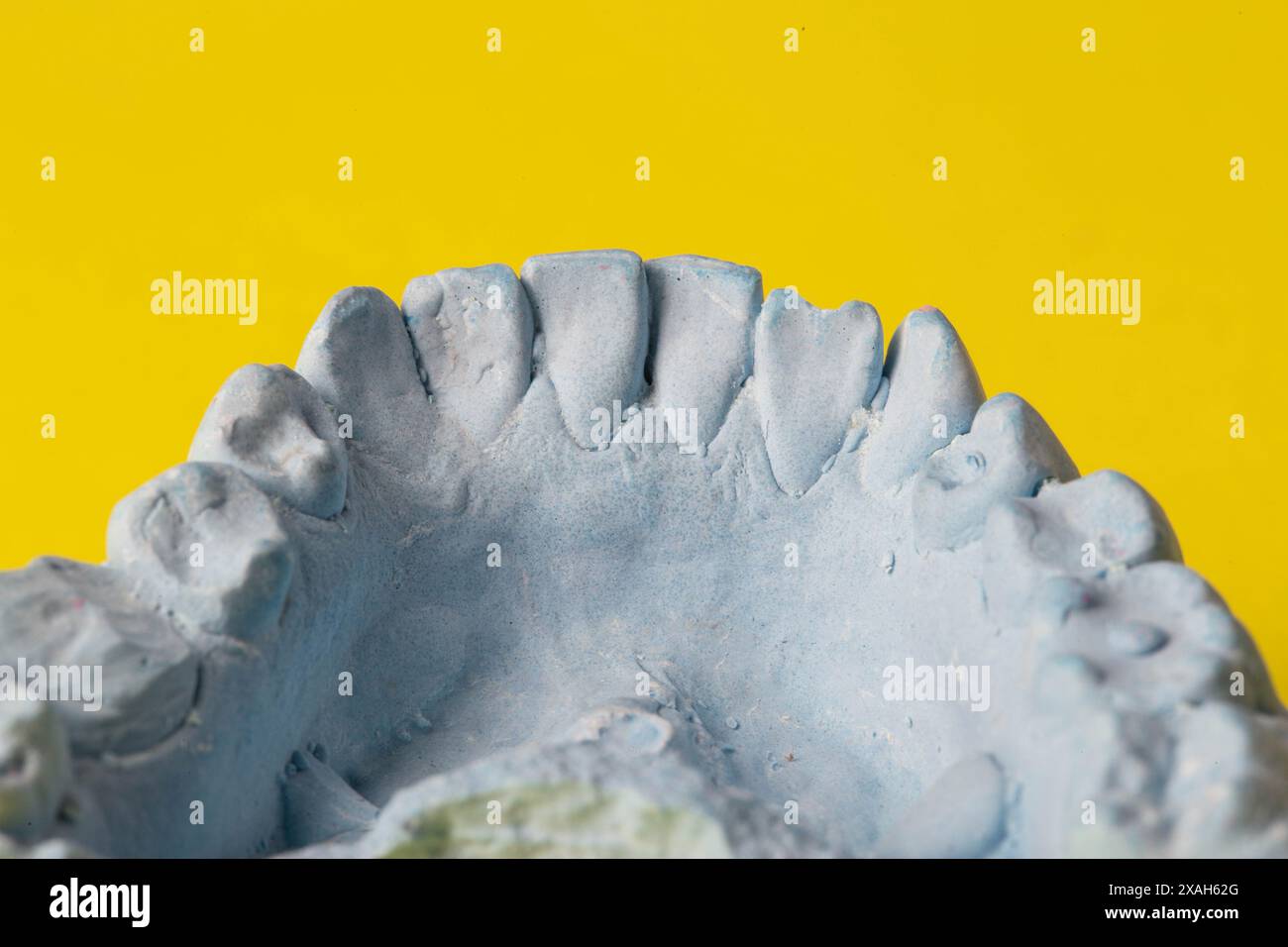 Intonaco blu impressione della mascella dentale di un paziente con denti storti e malocclusioni su sfondo giallo. Produzione di controventature per correggere il morso Foto Stock