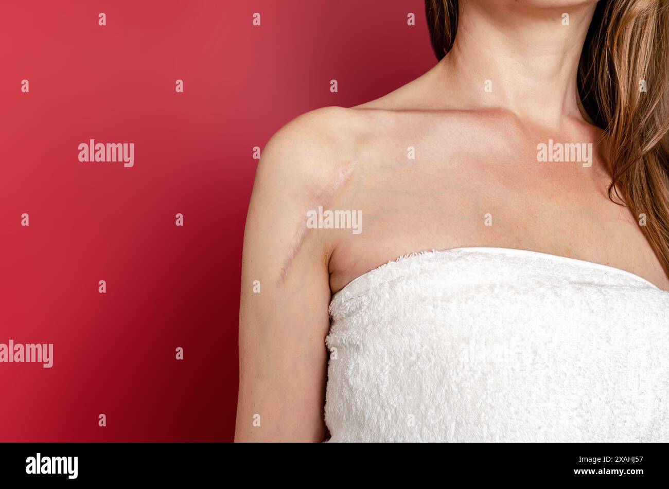 Cicatrice dopo un intervento chirurgico sulla spalla di una donna su sfondo rosso Foto Stock