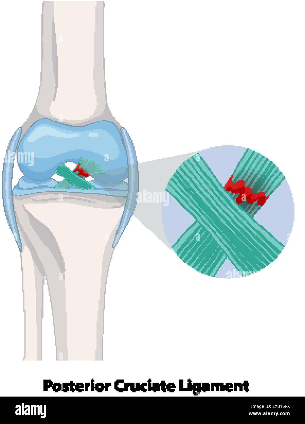 Illustrazione di una lacerazione del legamento del ginocchio Illustrazione Vettoriale