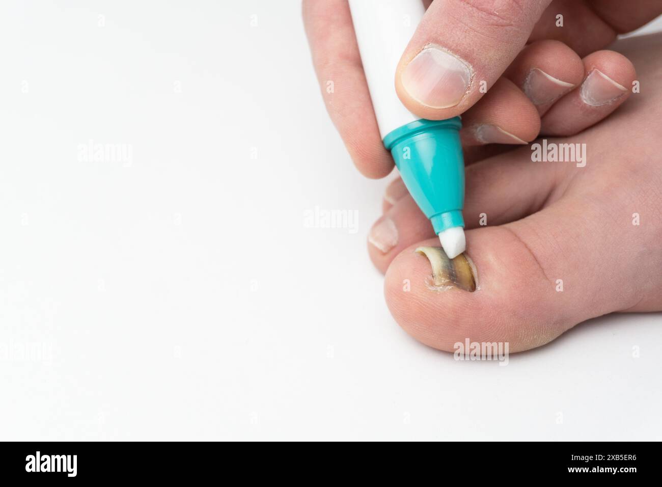 fungine chiodo infezione trattamento con penna primo piano isolato su spazio di copia bianco, mano maschio applicazione, uomo applica trattamento per curare fungo dell'unghia del piede (onyc Foto Stock
