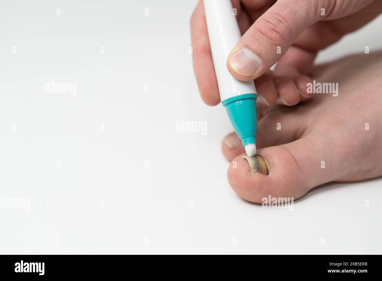 fungine chiodo infezione trattamento con penna primo piano isolato su spazio di copia bianco, mano maschio applicazione, uomo applica trattamento per curare fungo dell'unghia del piede (onyc Foto Stock