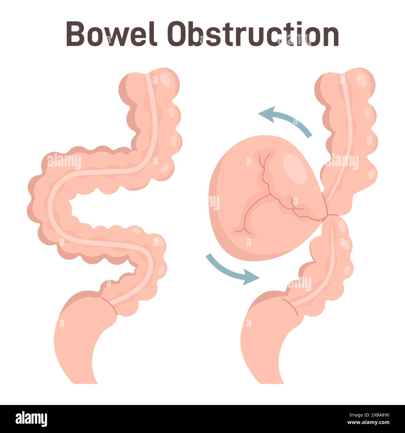 Ostruzione intestinale o volvolo. L'anello dell'intestino si torce intorno a se stesso. Malattia dell'apparato digerente umano. Organi interni addominali. Illustrazione vettoriale piatta Illustrazione Vettoriale