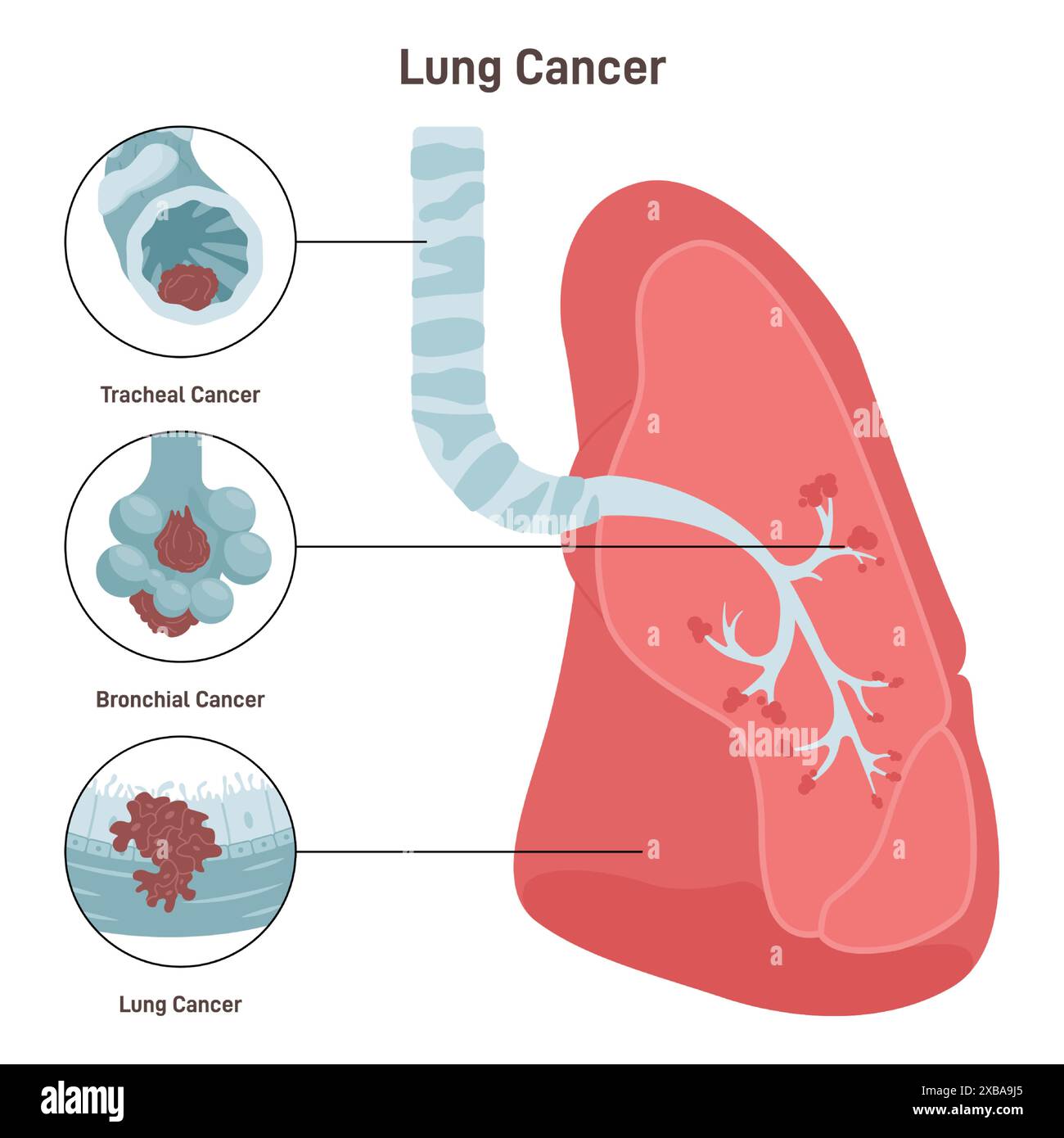 Cancro ai polmoni. Cellule maligne patologiche o tumore localizzato nel tessuto polmonare. Malattia del sistema polmonologico. Rischio di fumo. Illustrazione vettoriale piatta Illustrazione Vettoriale