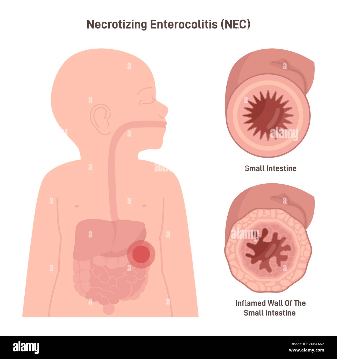 Enterocolite necrotizzante o NCA. Patologia gastrointestinale grave che colpisce principalmente i bambini prematuri, infiammazione del tessuto intestinale. Illustrazione vettoriale piatta Illustrazione Vettoriale