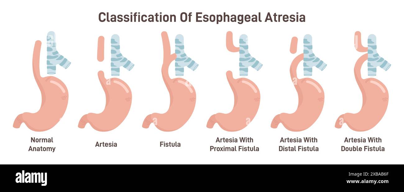 Set di tipi di atresia esofagea. Condizione medica congenita di trachea ed esofago fusione dei tratti, anomalia o difetto dell'esofago. Illustrazione vettoriale piatta Illustrazione Vettoriale