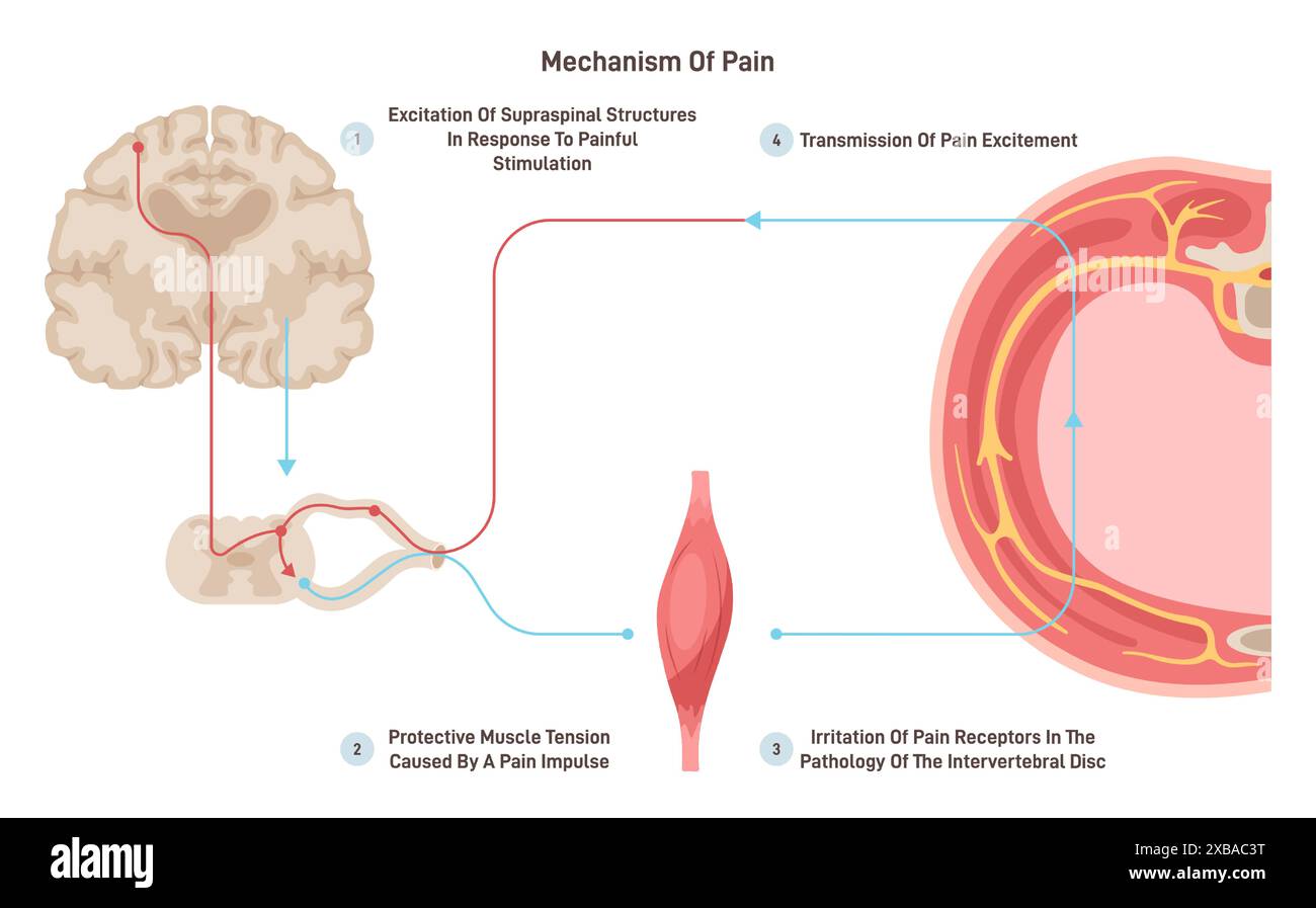 Anatomia e fisiologia del dolore. Reazione CNS o riflesso su stimolazione painfull. Schema scientifico neurologico. Illustrazione vettoriale piatta Illustrazione Vettoriale