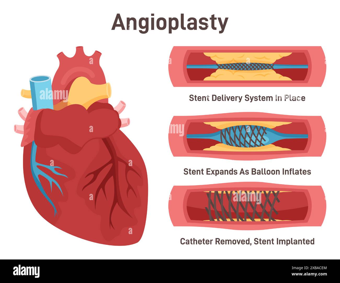 Angioplastica. Erogazione e impianto di stent. Catetere palloncino sgonfiato inserito in un'arteria coronaria. Stent che espande la parete di un vaso sanguigno. Illustrazione vettoriale piatta Illustrazione Vettoriale