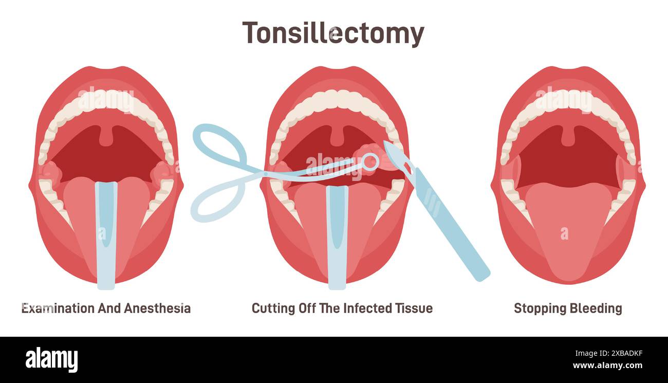 Tonsillectomia. Trattamento della faringite acuta, rimozione chirurgica delle tonsille, due tamponi ovali di tessuto nella parte posteriore della gola. Illustrazione vettoriale piatta Illustrazione Vettoriale