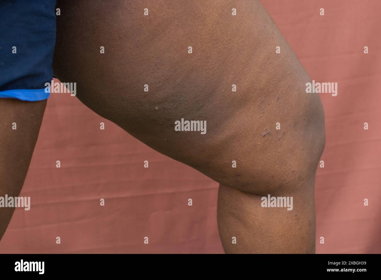 Coscia interna scura su pelle marrone, iperpigmentazione e oscuramento della coscia interna su pelle marrone Foto Stock