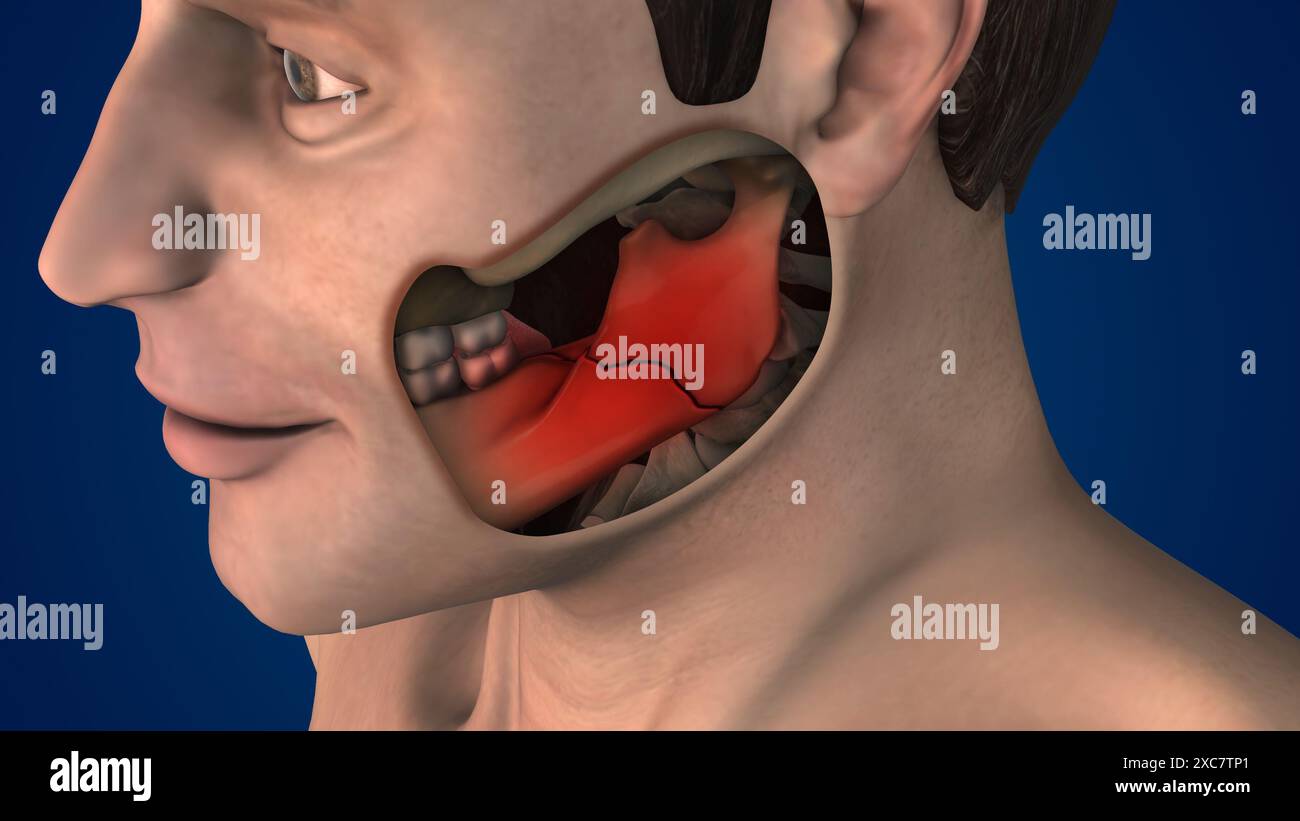 Frattura con vista laterale dell'osso della mandibola Foto Stock