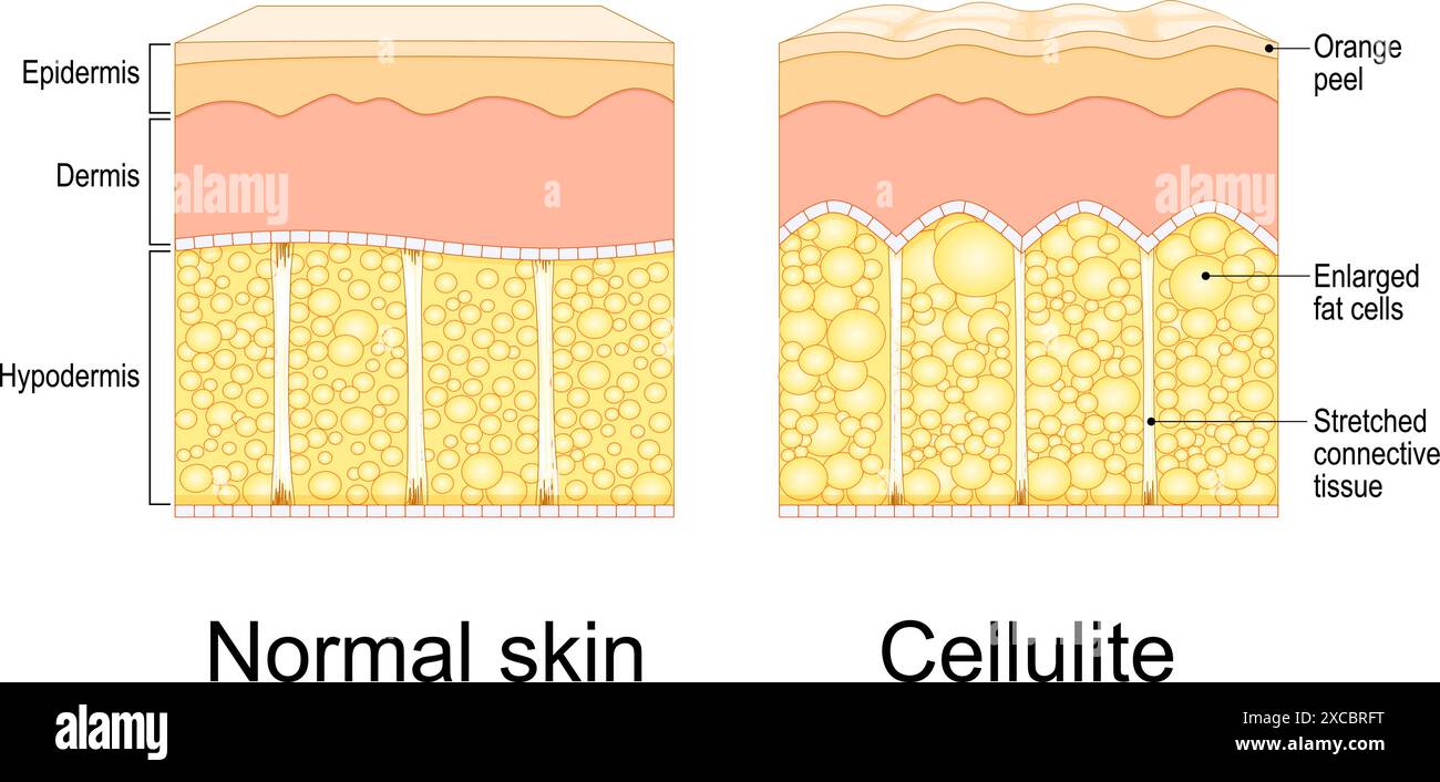 Formazione di cellulite. Sindrome della buccia d'arancia. Adiposis edematosa. Sezione trasversale di cellulite e pelle sana. Anatomia cutanea. Tessuto adiposo del corpo umano. V Illustrazione Vettoriale