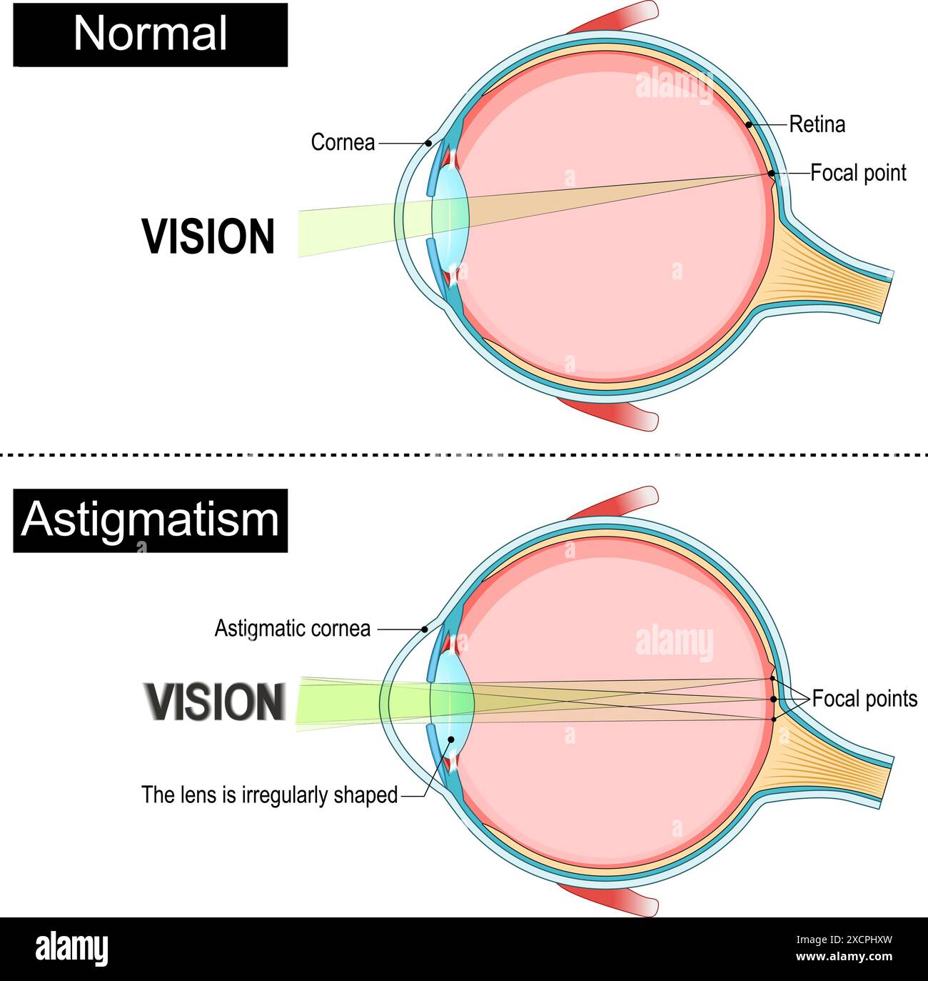 Astigmatismo. Anatomia degli occhi. Obiettivo, cornea e punti focali sulla retina nell'occhio normale e astigmatico. Sezione trasversale di un occhio umano. Diagramma per l'istruzione Illustrazione Vettoriale