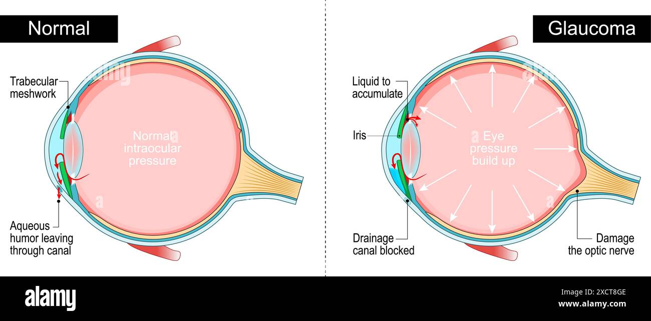 Glaucoma. Sezione trasversale di un occhio umano. Pressione intraoculare. Perdita della vista. Anatomia degli occhi. Diagramma per l'istruzione e l'uso medico. Illustrazione vettoriale Illustrazione Vettoriale