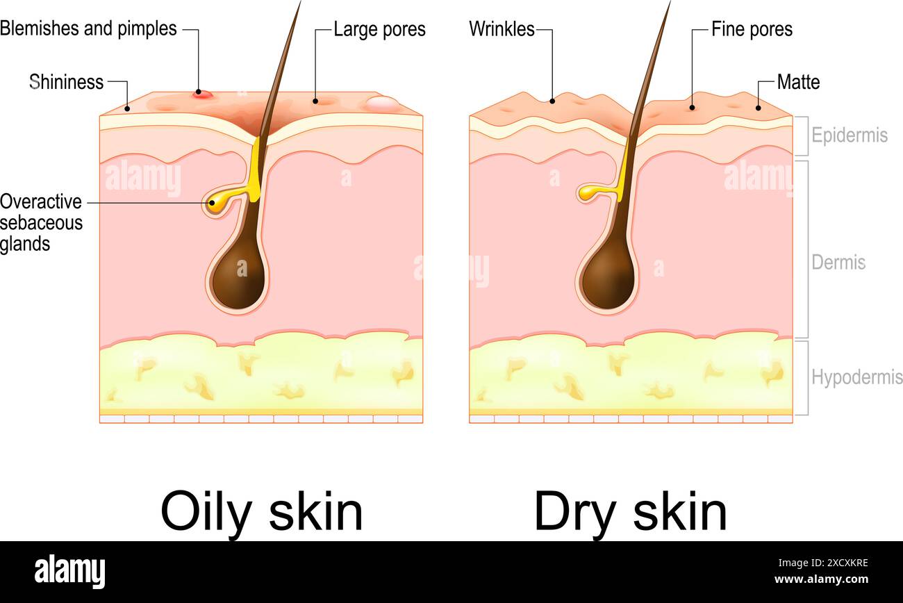 Pelle grassa e asciutta. Tipi di pelle. Sezione trasversale di una pelle umana con rughe, pori, imperfezioni e brufoli, capelli e ghiandole sebacee. Poster vettoriale Illustrazione Vettoriale