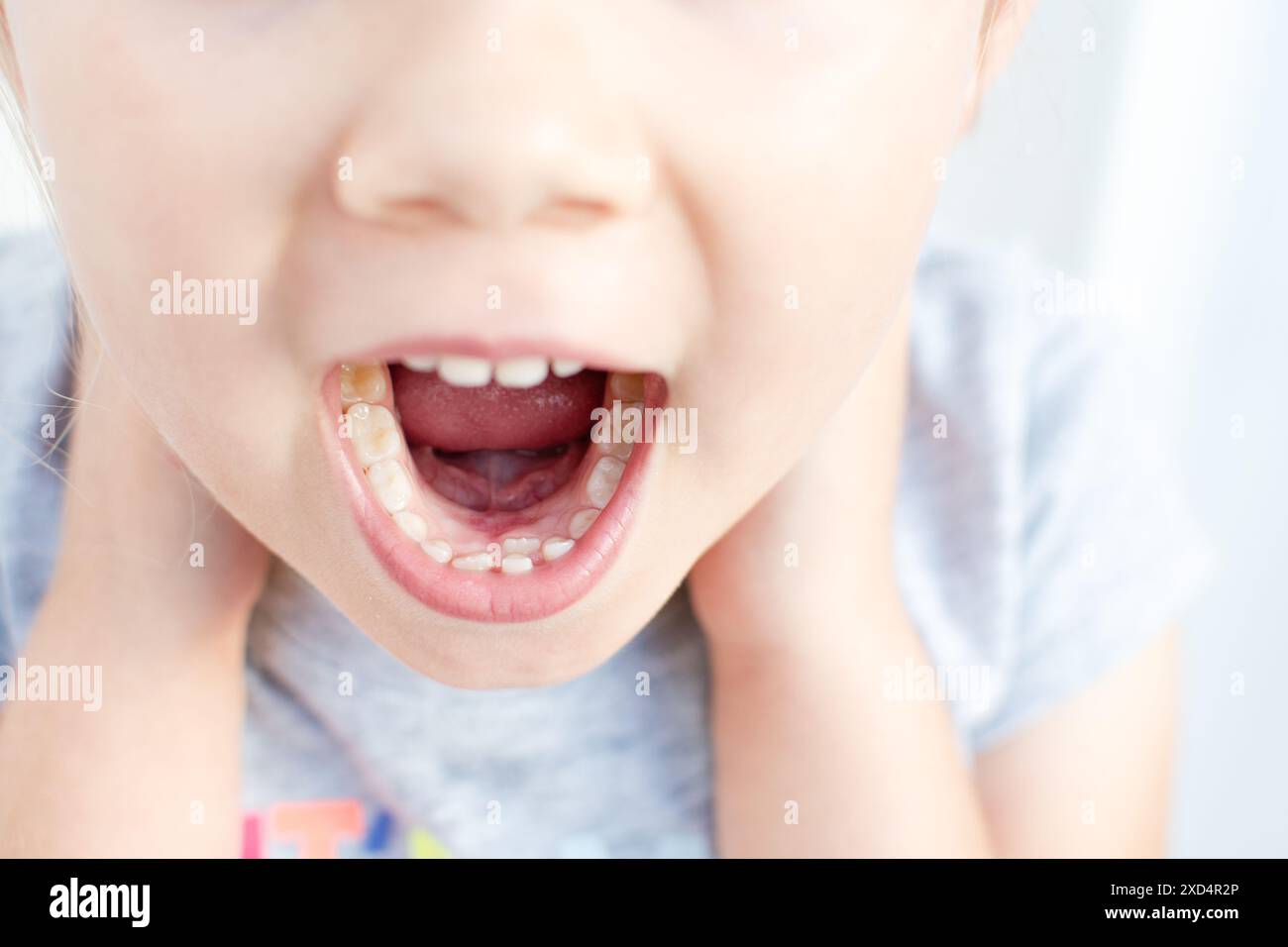 Denti permanenti per adulti che vengono davanti ai denti del bambino: Denti dello squalo. La bocca aperta della bambina. Foto Stock