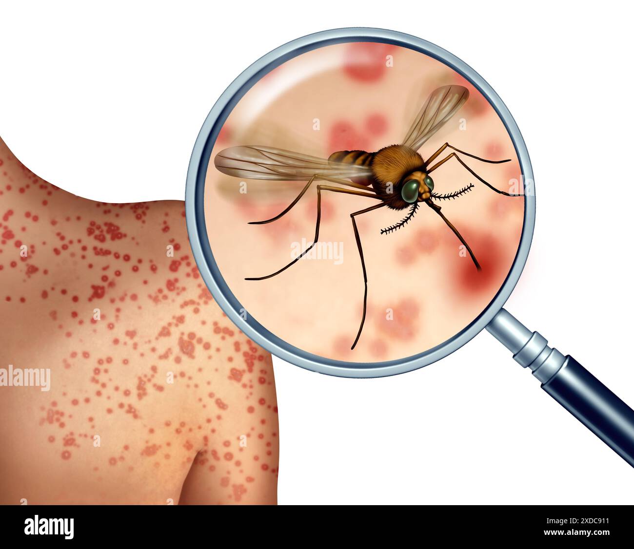 Zanzare morsi e zanzare rischio orzanzare all'aperto che trasmettono infezioni dannose come la malaria e la diffusione del virus. Foto Stock