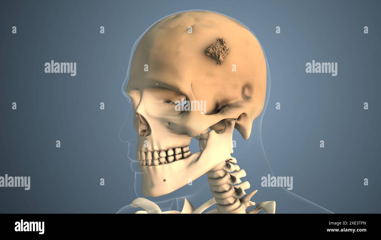 Cancro che si diffonde lungo un osso cranico Foto Stock