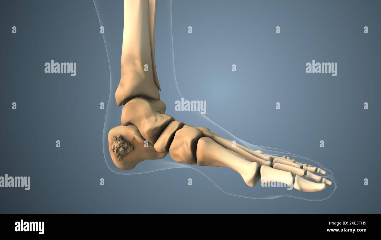 Diffusione del cancro lungo l'osso del piede Foto Stock