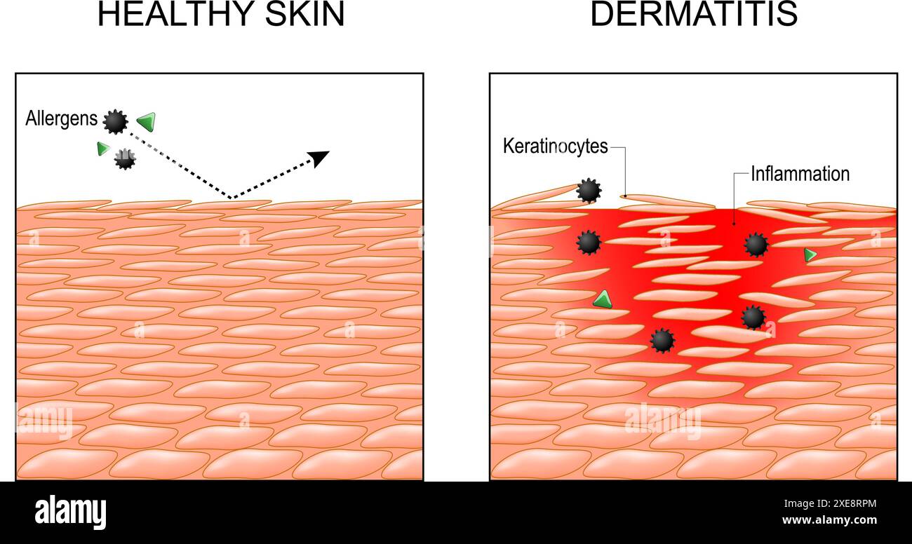 Dermatite. Eczema. Psoriasi. Sezione trasversale di una pelle umana. Primo piano dell'epidermide infiammatoria. Penetrazione di allergeni nella pelle. Dermatite atopica. Illustrazione Vettoriale