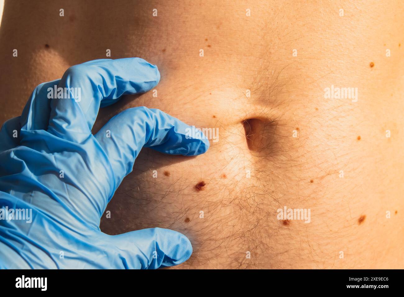 Dermatologo che controlla le voglie maschili. Medico in guanti medici che esaminano la talpa della pelle dell'uomo. Autoassistenza per prevenire il cancro. Foto Stock