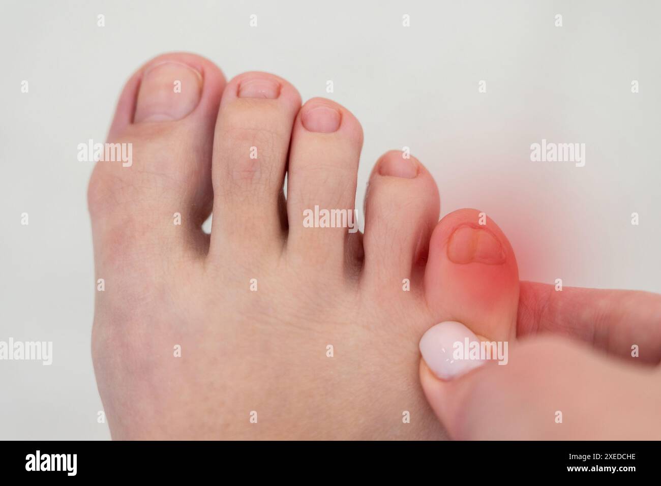Infiammazione del piede femminile con macchia rossa. Concetto di dolore ai piedi e malattia Foto Stock