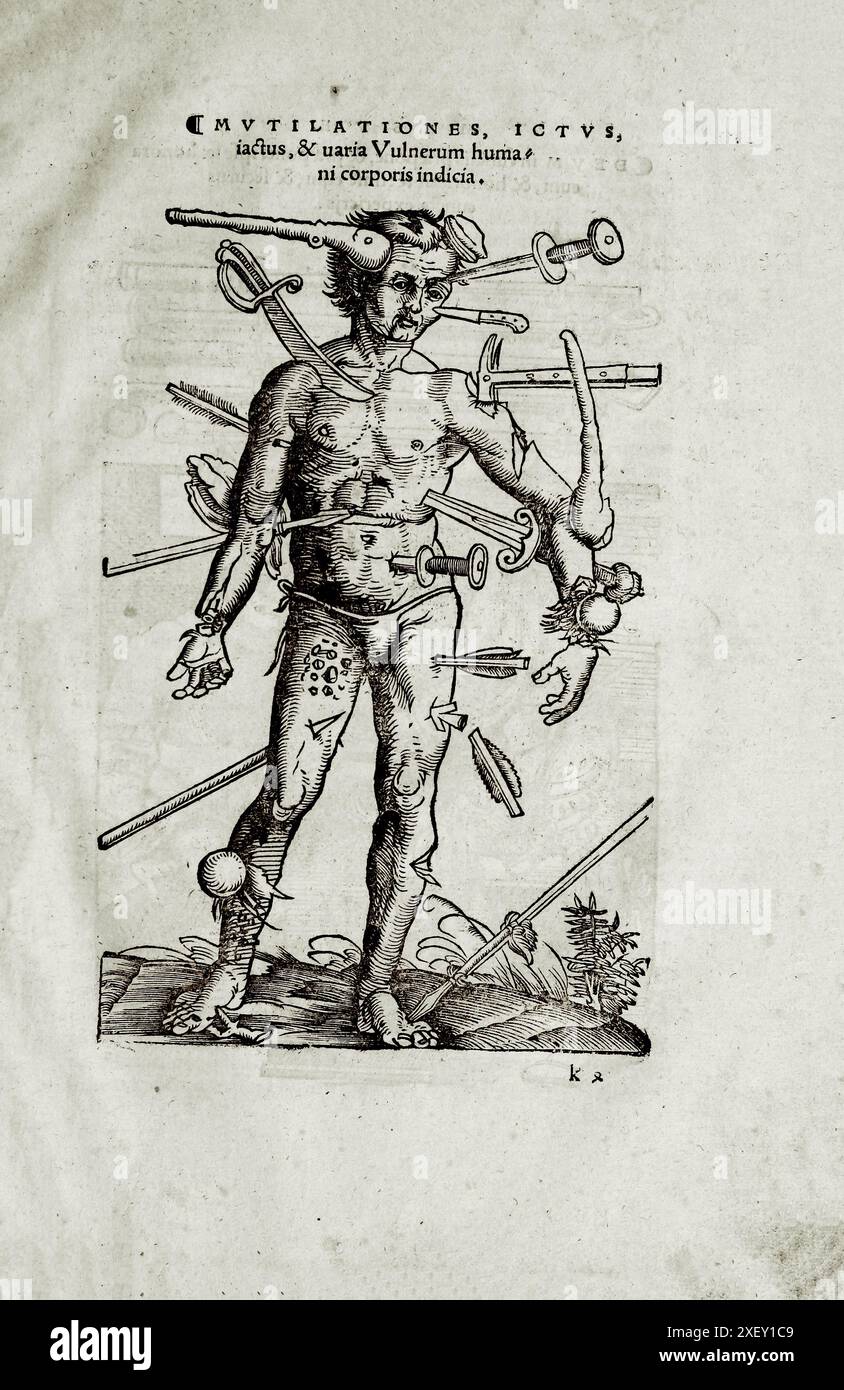 L'illustrazione cinquecentesca della chirurgia e delle operazioni chirurgiche nel Medioevo: Mutilationes, tap, lividi e diverse versioni delle ferite dei sintomi del corpo umano. Dai libri medievali di Ottavio Horatiano e Abu al-Qasim Khalaf ibn al-Abbas al-Zahrawi. Strasburgo. Johann Schott, 1532 anni. Foto Stock