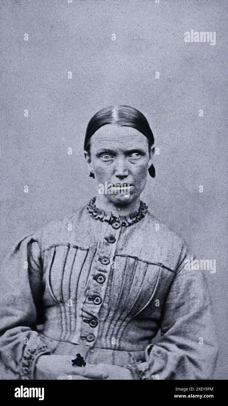 Una fotografia in bianco e nero di Elizabeth Hardcastle, una paziente al West Riding Lunatic Asylum di Wakefield, Yorkshire. La fotografia, attribuita a James Crichton-Browne, è stata scattata nel 1872. Hardcastle è raffigurato seduto, guardando direttamente la telecamera, con un'espressione seria. Indossa un semplice abito con bottoni e un colletto fronteggiato. La fotografia cattura un momento nel tempo, offrendo uno sguardo alla vita di coloro che sono confinati in asili durante l'era vittoriana. Foto Stock