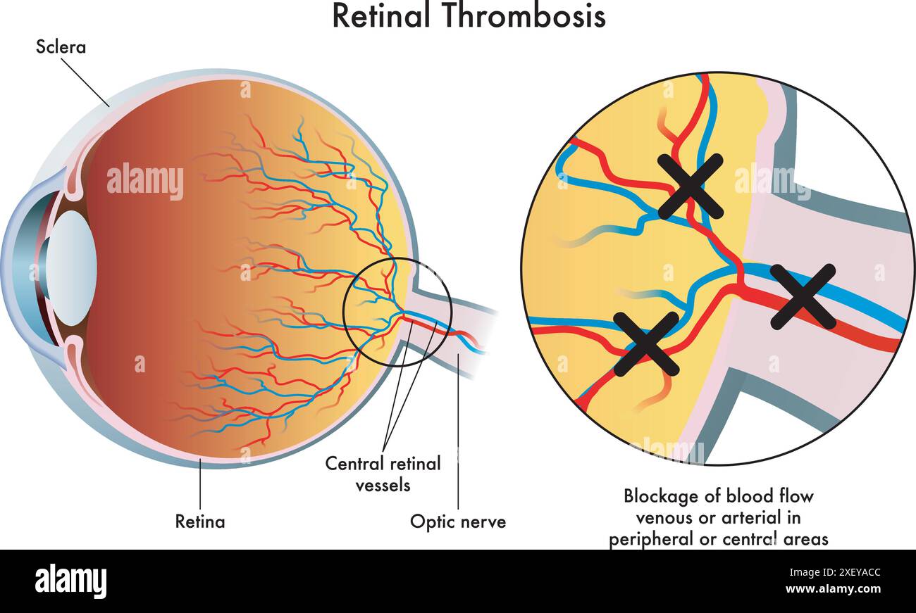 L'illustrazione medica mostra le conseguenze della trombosi retinica Illustrazione Vettoriale