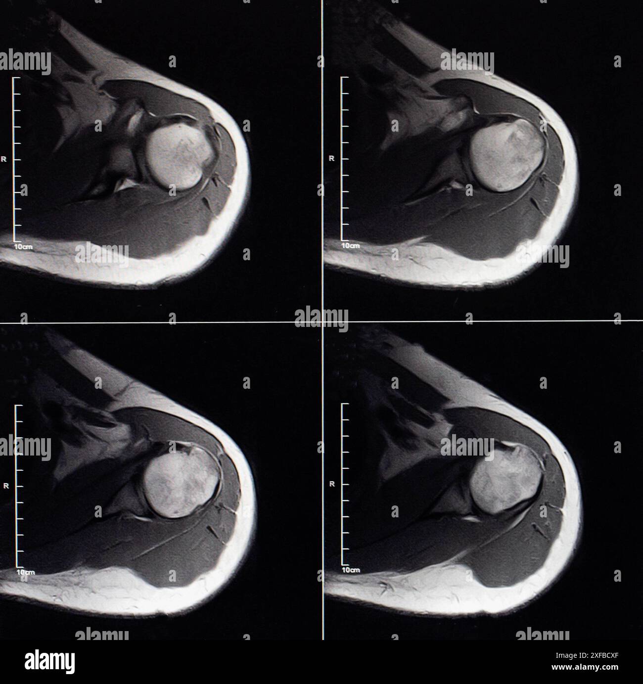 Immagine MRI dell'articolazione della spalla dopo una frattura e una lussazione. Impressione di frattura della testa dell'omero. Danno alla capsula articolare, deformattazione articolare Foto Stock