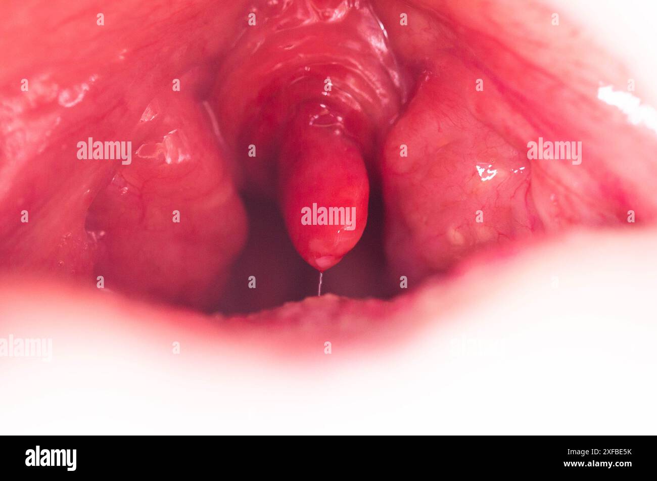 Uvula rossa, infiammata e gonfia in gola. Trattamento dell'uvulite dovuta a batteri e virus streptococcici. Otolaringologia Foto Stock
