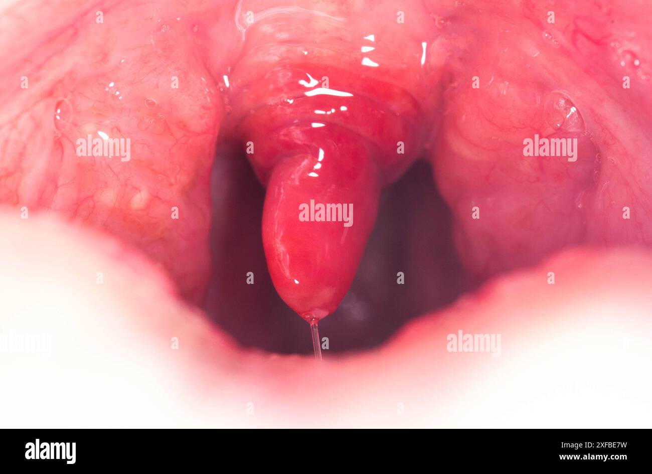 Uvula rossa, infiammata e gonfia in gola. Trattamento dell'uvulite dovuta a batteri e virus streptococcici. Otolaringologia Foto Stock