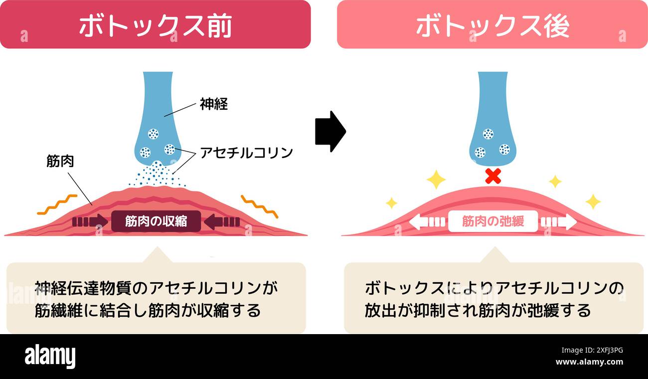 Meccanismo di rilassamento muscolare di Botox. Illustrazione vettoriale. Illustrazione Vettoriale