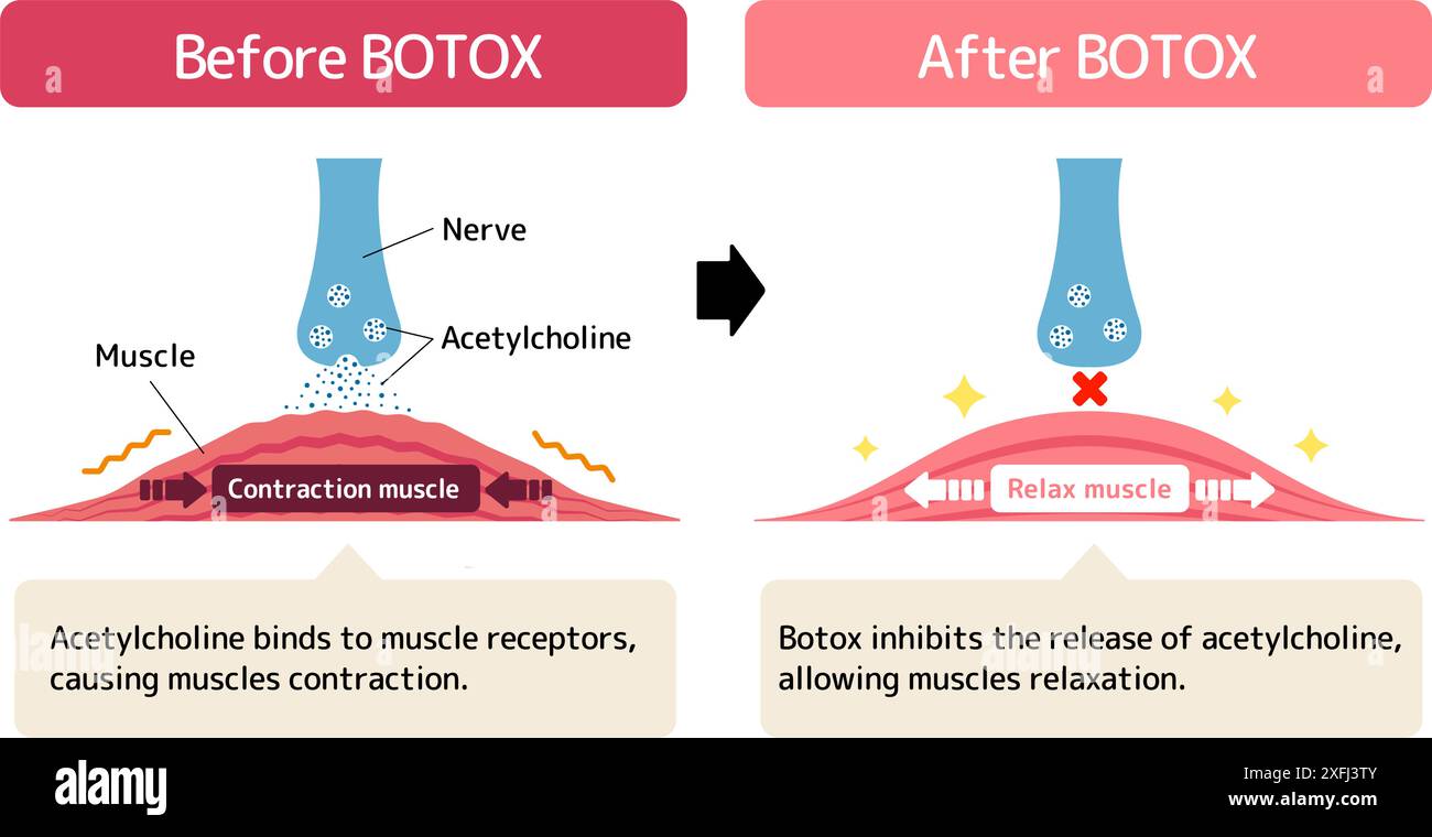 Meccanismo di rilassamento muscolare di Botox. Illustrazione vettoriale. Illustrazione Vettoriale