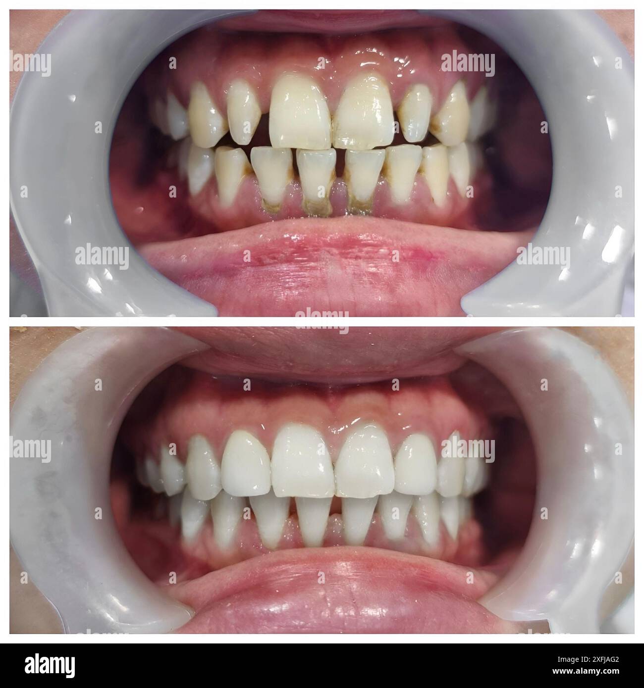Prima e dopo il trattamento di grande spazio tra i denti anteriori chiamato diastema Foto Stock