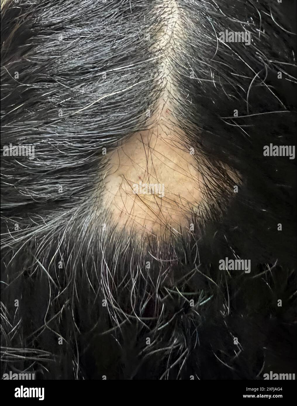 Vista ravvicinata del cuoio capelluto di una donna, rivelando una notevole perdita di capelli dovuta all'alopecia Foto Stock