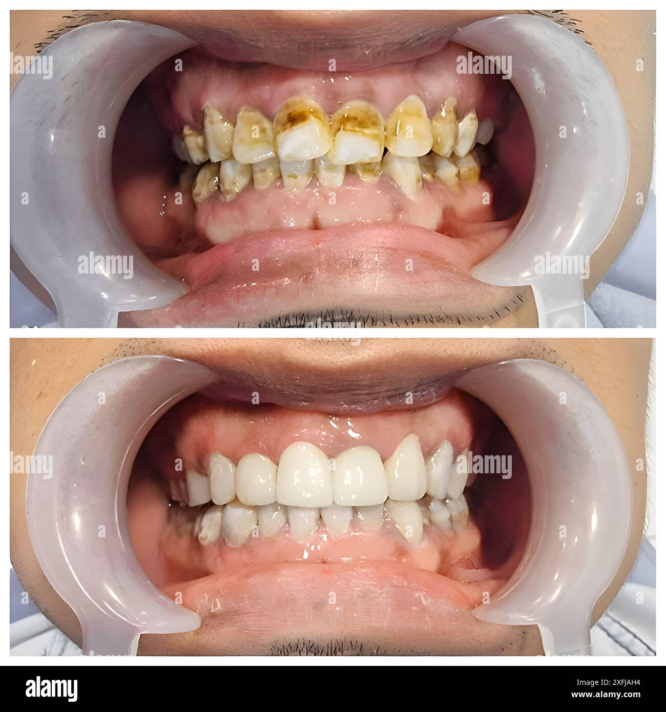 la nicotina liquida macchia i denti Macchia i denti immagini e fotografie stock ad alta risoluzione