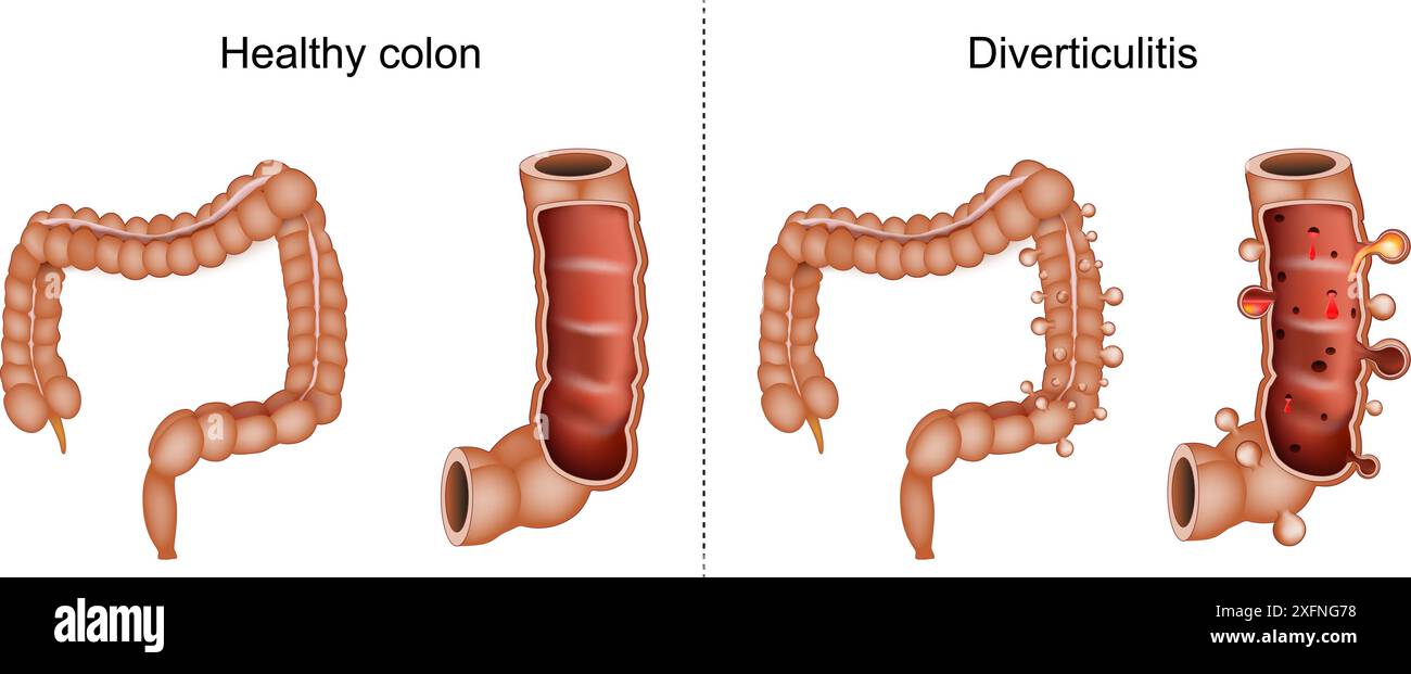 Diverticolite. Sezione trasversale di un colon con sanguinamento e infiammazione di sacchetti o diverticoli anomali. Confronto e differenza tra una salute Illustrazione Vettoriale