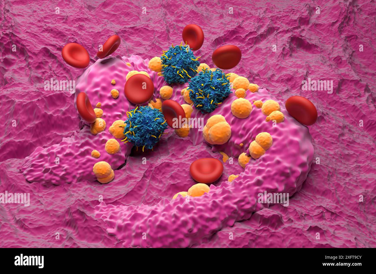 Terapia con cellule T di CAR nel carcinoma basale a cellule (BCC) - Vista isometrica illustrazione 3d. Foto Stock