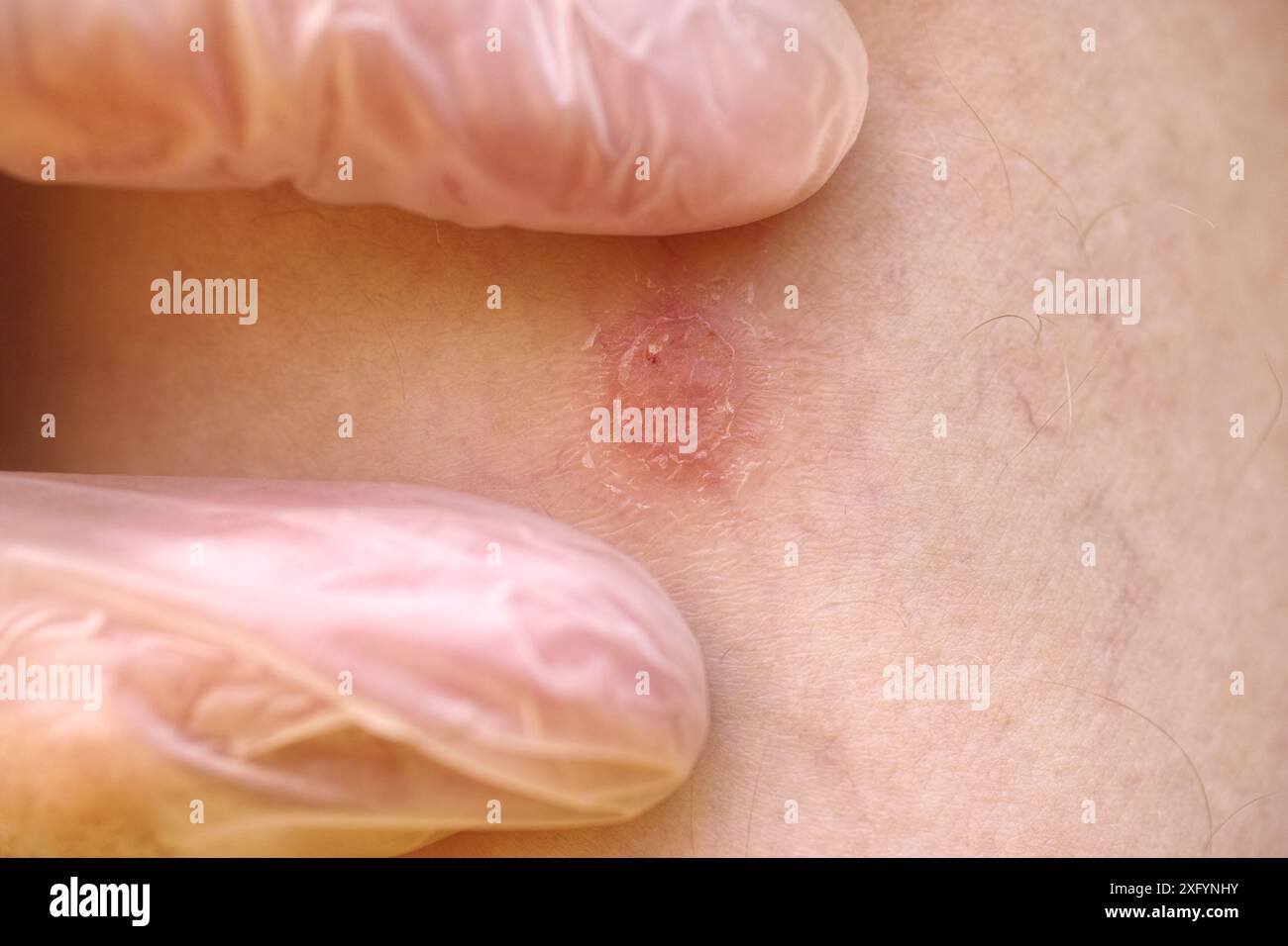 Un dermatologo che esamina una placca psoriasi sulla gamba di un paziente. Primo piano. Foto Stock