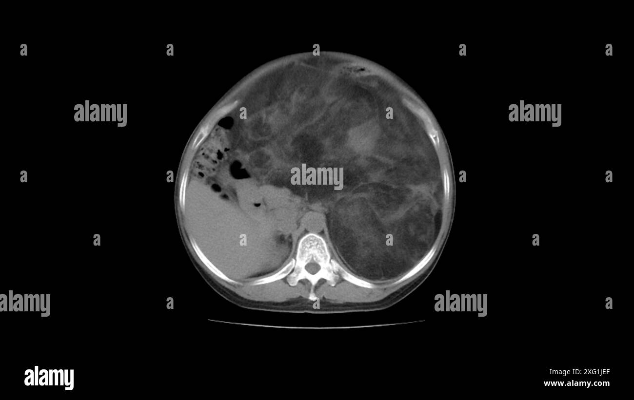 Tomografia computerizzata (TC) scansione dell'addome di un paziente con un grande liposarcoma (scuro, centro-destro). I liposarcomi sono tumori maligni (cancerosi) che si sviluppano dal tessuto adiposo. Si tratta di tumori a crescita lenta che difficilmente si diffonderanno (metastasi). Il trattamento avviene con la rimozione chirurgica del tumore, tuttavia spesso si ripresentano. Foto Stock